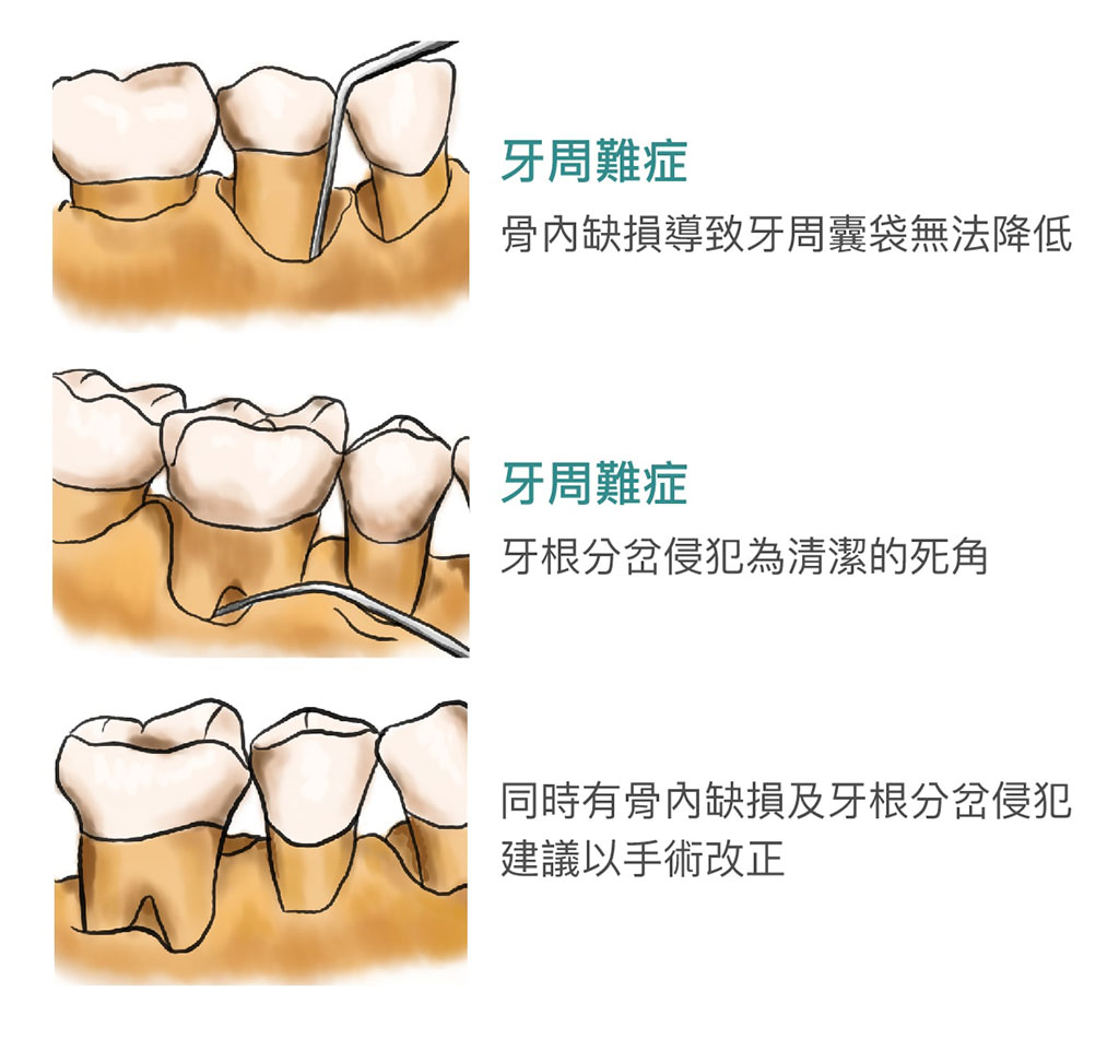 牙周手術治療目標，恢復牙周組織，改善牙周環境-牙周病治療