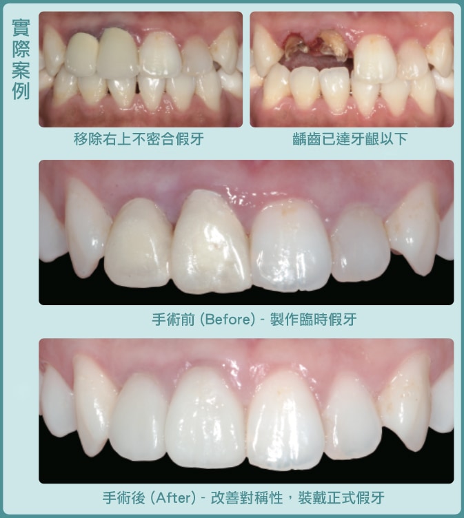牙周整形手術-牙冠增長術-術前術後變化-葉立維醫師-桃園