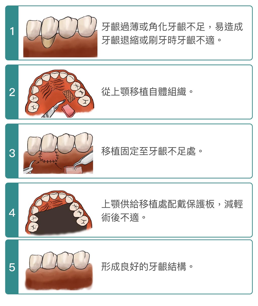 牙根覆蓋術-手術步驟-牙齦手術-葉立維醫師-桃園