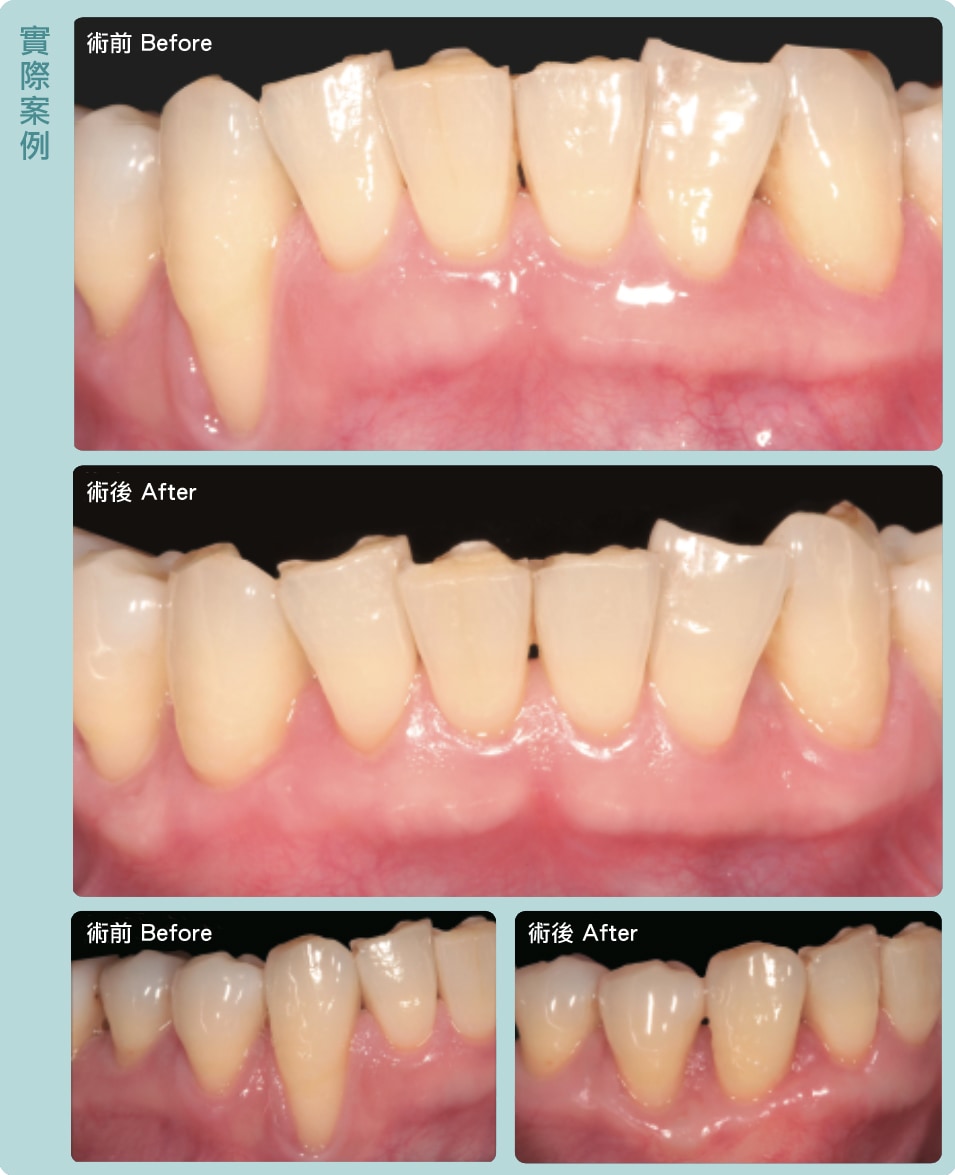 牙根覆蓋術-牙齦手術-術前術後比較-葉立維醫師-桃園