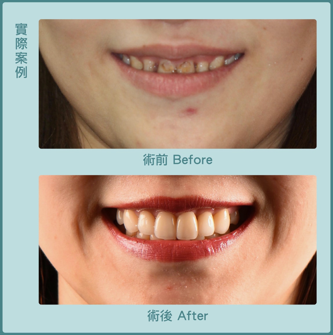 牙冠增長術-笑露牙齦-瓷牙貼片-術前術後比較-葉立維醫師-桃園