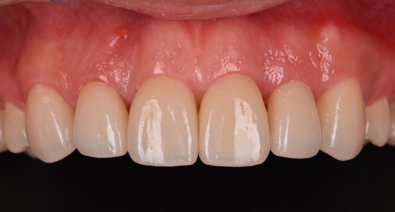 牙周病治療-陶瓷貼片-數位牙科-牙周手術後-牙冠增長術-中壢-桃園-葉立維醫師