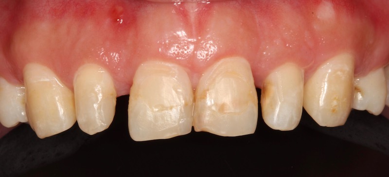 牙周病治療-陶瓷貼片-數位牙科-牙周手術-牙冠增長術-中壢-桃園-葉立維醫師