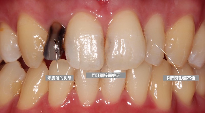 牙周病治療-陶瓷貼片-數位牙科-治療前-門牙蛀牙-牙齒型態不佳-中壢-桃園-葉立維醫師