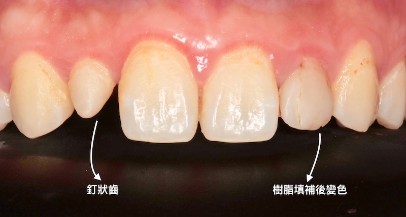 牙周病治療-陶瓷貼片-數位牙科-治療前-釘狀齒-補牙變色-中壢-桃園-葉立維醫師