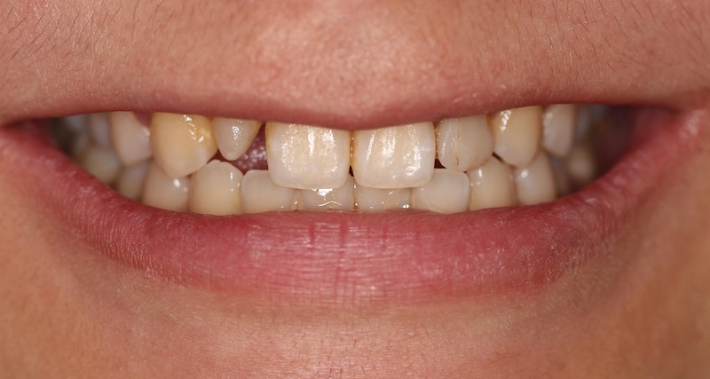 牙周病治療-陶瓷貼片-數位牙科-治療前-前牙咬合-中壢-桃園-葉立維醫師