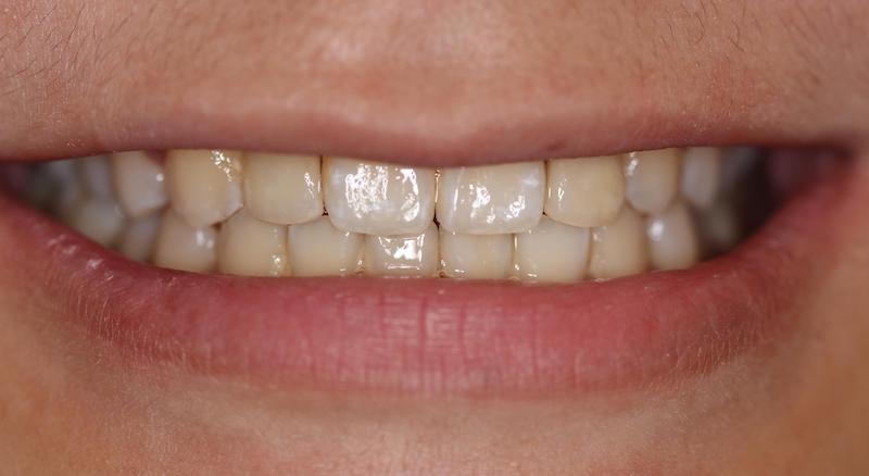 牙周病治療-陶瓷貼片-數位牙科-治療後-前牙咬合-中壢-桃園-葉立維醫師