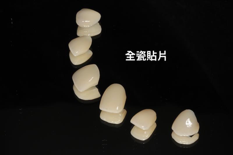 牙周病-治療-數位牙科-陶瓷貼片-全瓷冠-數位牙科與全瓷修復-製作完成的陶瓷貼片-可用於牙周治療後的美觀修復