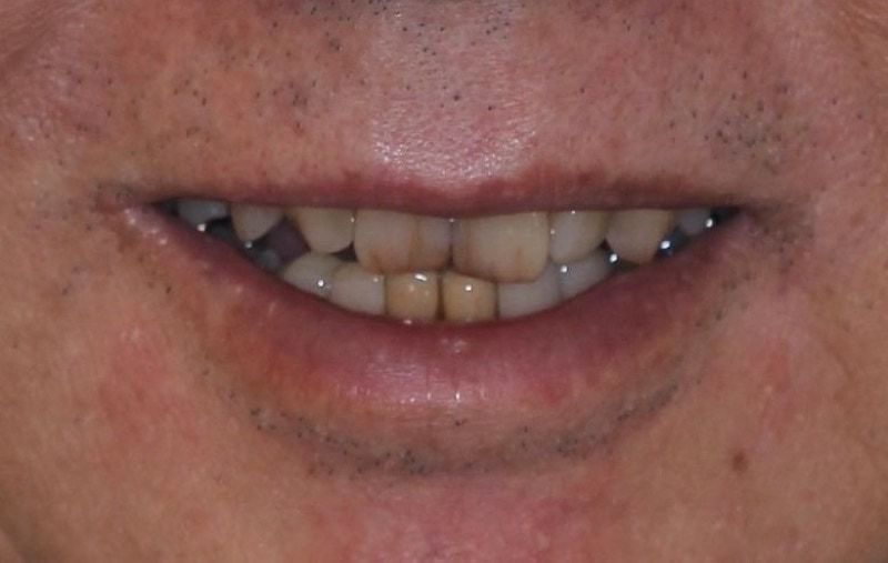 先天缺牙-犬齒較尖-全瓷修復前