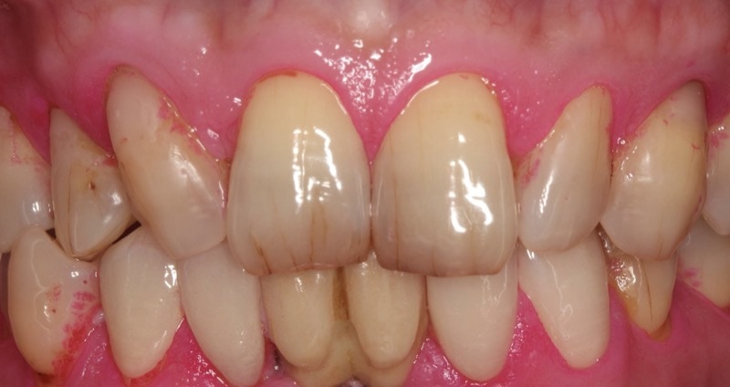 中度牙周病治療案例-牙周病治療後-全瓷貼片-左下側門牙-犬齒