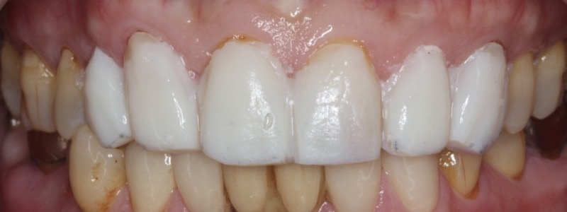 患者在術前試戴陶瓷貼片，方便和醫師討論上排微笑曲線的牙齒型態