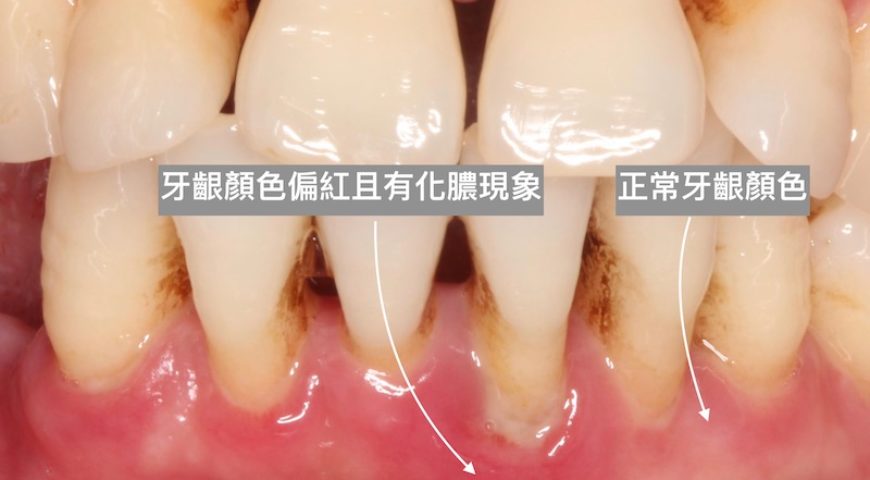 「牙周病」你該知道的牙周病原因、症狀與治療注意事項