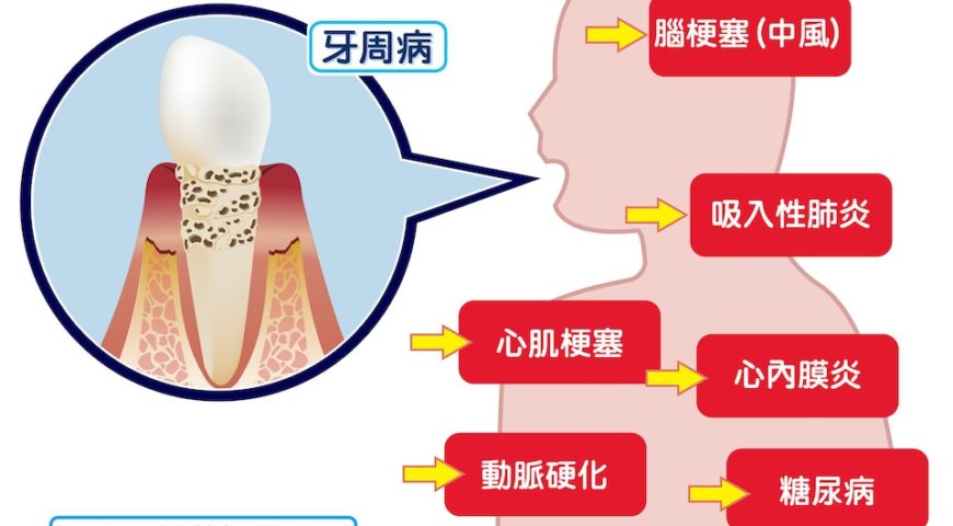 牙周病莫輕忽，不及早治療恐影響全身健康！