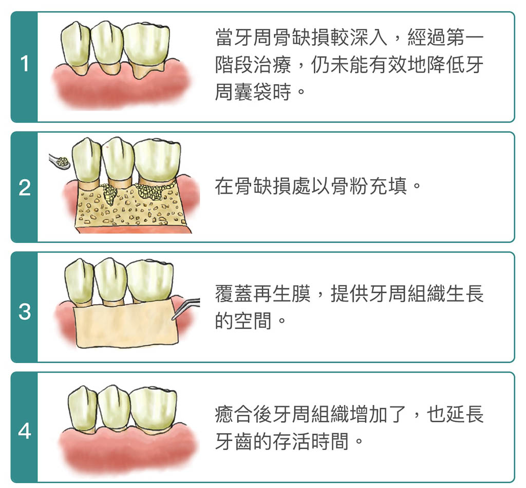 牙周病手術-牙周再生手術-手術步驟