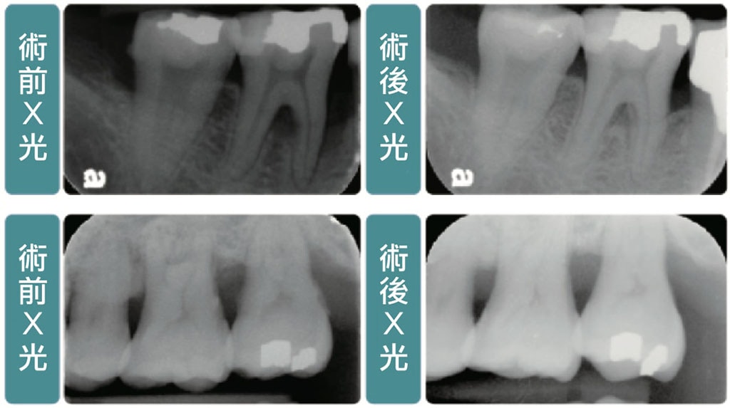 牙周病手術-牙周翻瓣手術-骨修整手術-手術前後X光比較