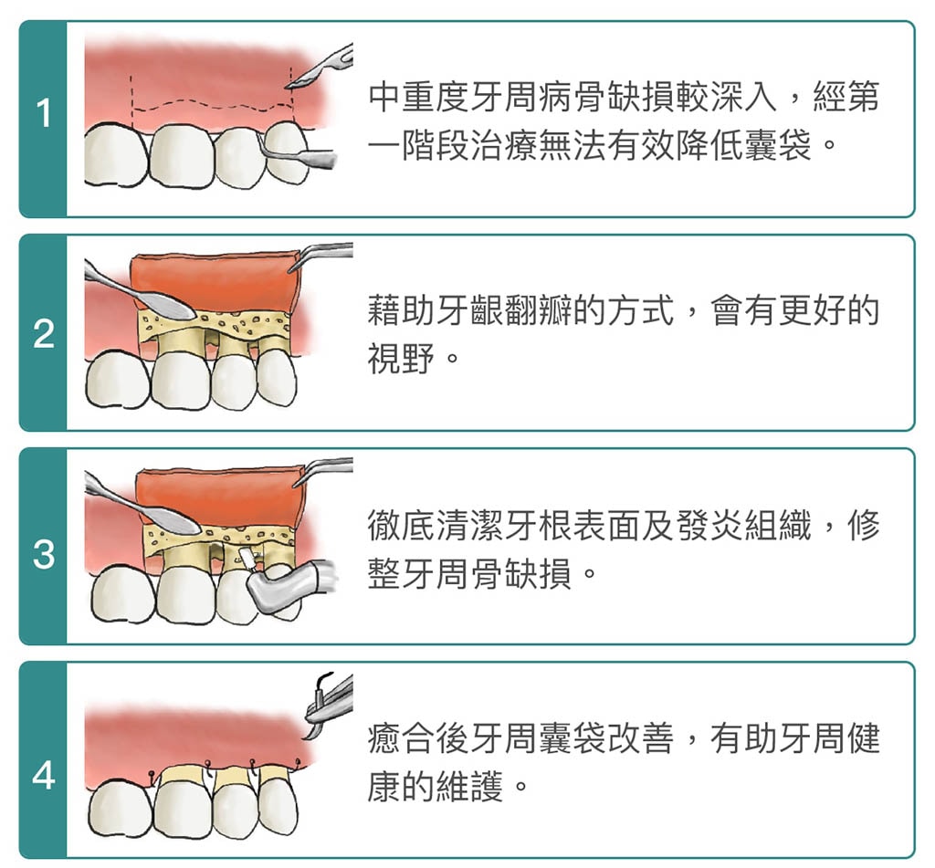 牙周病手術-牙周翻瓣手術-骨修整手術-手術步驟