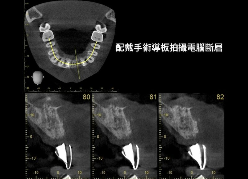 牙周病植牙-人工植牙-數位導航植牙-鎮靜植牙手術-傳統牙科植牙手術-採用傳統手術導板拍攝X光協助拍攝的電腦斷層CT