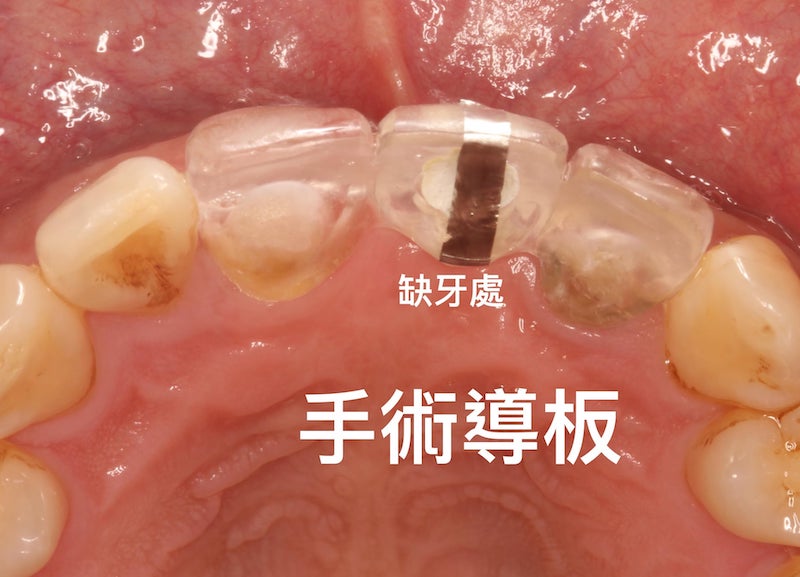 牙周病植牙-人工植牙-數位導航植牙-鎮靜植牙手術-傳統牙科植牙手術-採用傳統手術導板拍攝X光或斷層影像