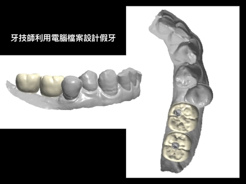 牙周病植牙-人工植牙-數位導航植牙-鎮靜植牙手術-數位化植牙案例-牙技師依數位模型製作植牙假牙