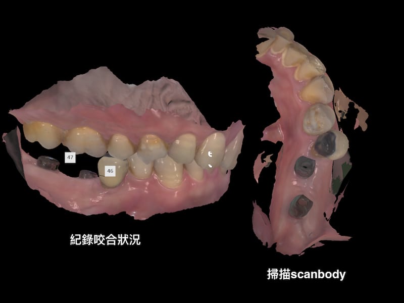 牙周病植牙-人工植牙-數位導航植牙-鎮靜植牙手術-數位化植牙案例-鎖入人工牙根後-再掃描相對位置