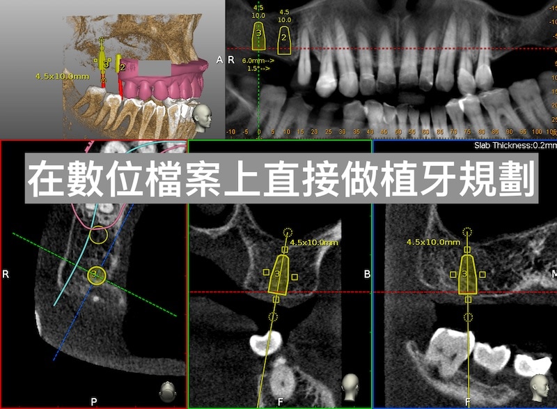 牙周病植牙-人工植牙-數位導航植牙-鎮靜植牙手術-數位牙醫科技-可以在數位檔案上直接做植牙規劃