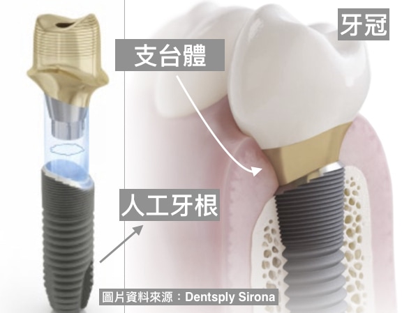 牙周病植牙-人工植牙-數位導航植牙-鎮靜植牙手術-植牙指將人工牙根植入齒槽骨-在上安裝假牙