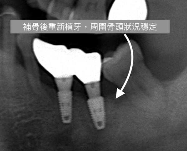 牙周病植牙-人工植牙-數位導航植牙-鎮靜植牙手術-植體周圍炎-補骨手術半年後骨再生效果佳-重新置入牙根進行植牙手術