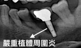 牙周病植牙-人工植牙-數位導航植牙-鎮靜植牙手術-植體周圍炎-齒槽骨嚴重破壞-須移除舊有牙根