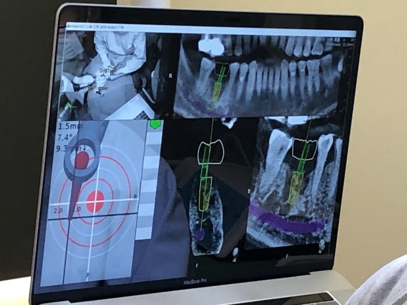 牙周病植牙-人工植牙-數位導航植牙-鎮靜植牙手術-透過數位導航植牙科技-植牙精準又安全