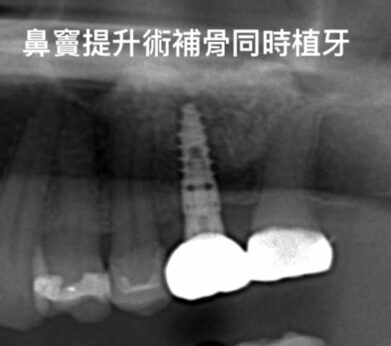 牙周病植牙-人工植牙-數位導航植牙-鎮靜植牙手術-鼻竇提升術補骨並同時人工植牙