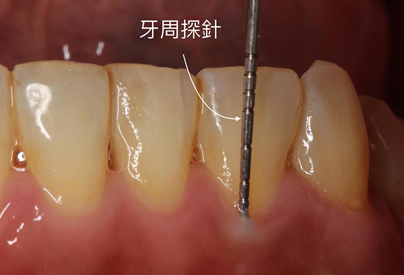 牙周病檢查-牙周探針-測量牙周囊袋