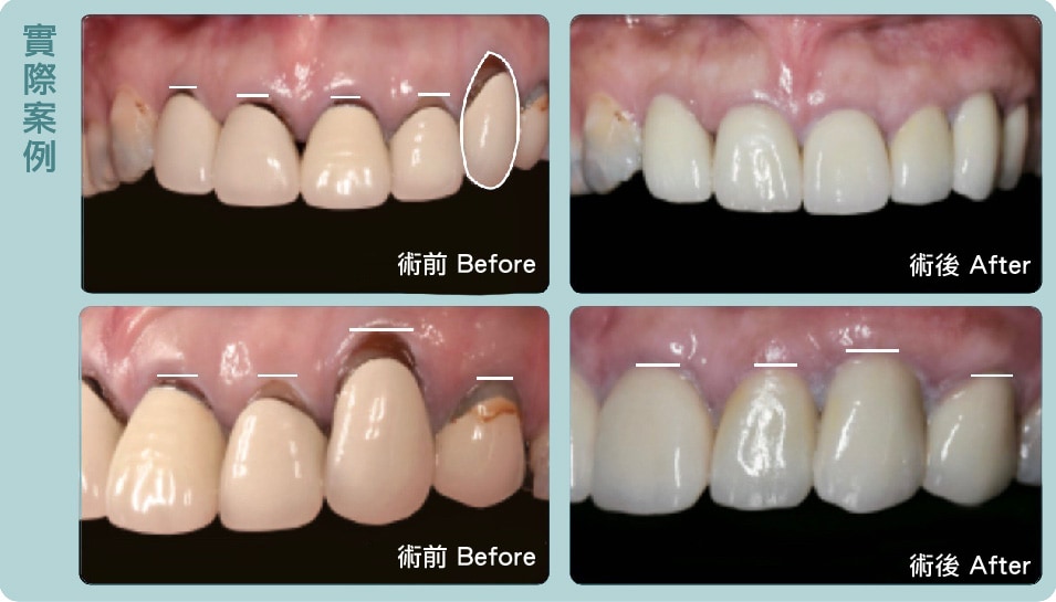 牙根覆蓋術-案例-更換假牙-葉立維醫師-桃園