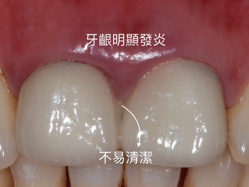 牙齦發炎-生物寬度-牙冠增長術