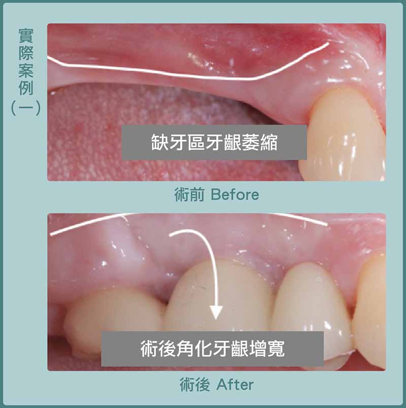 缺牙-牙齦凹陷-牙齦萎縮補肉-游離牙齦移植術-手術前後比較-葉立維醫師-桃園