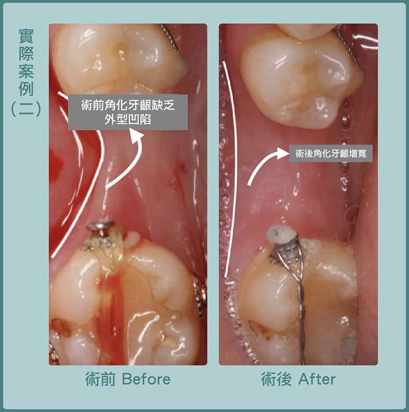 缺牙-牙齦凹陷-牙齦萎縮補肉-游離牙齦移植術-手術前後比較-葉立維醫師-桃園
