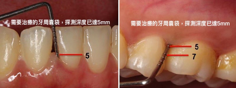 需要治療的牙周囊袋-探測深度已達5mm-不易清潔乾淨.jpg