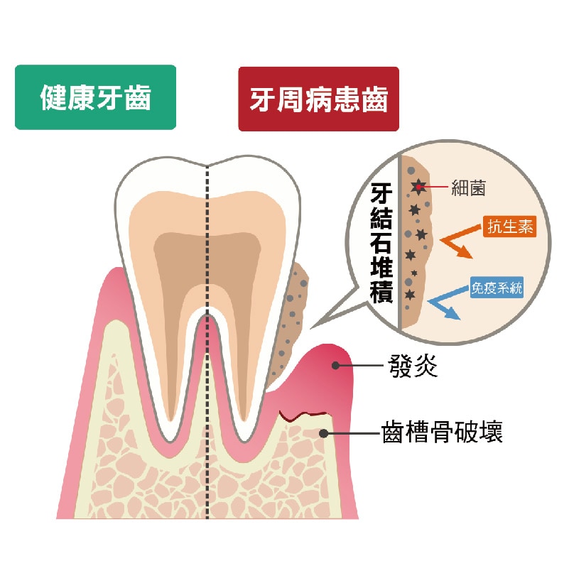 健康牙齒-牙周病患齒-齒槽骨破壞-牙周囊袋-桃園牙周病-葉立維醫師