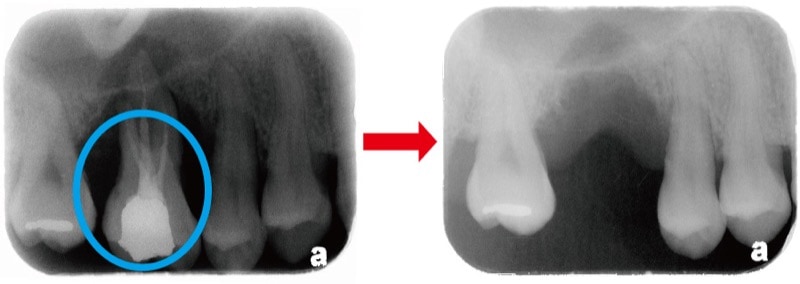 嚴重牙周病-牙周病拔牙-缺牙-X光片-牙周翻瓣手術案例