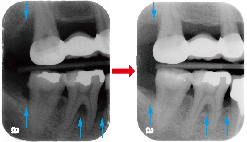 嚴重牙周病不拔牙-牙周再生手術-術前術後-右側後牙區-X光片-骨頭再生