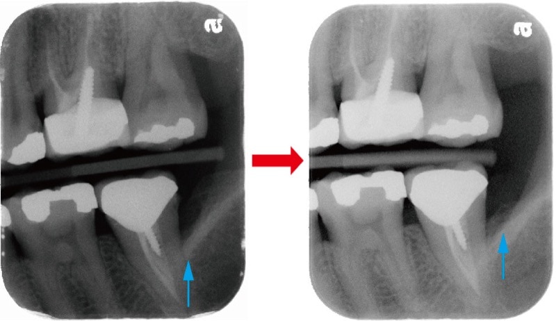 嚴重牙周病不拔牙-牙周再生手術-術前術後-左側後牙區-X光片-骨頭再生