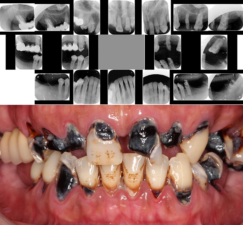 嚴重牙周病經驗治療案例-全口嚴重牙周病-口腔與牙齒X光照-葉立維醫師-牙周病-桃園