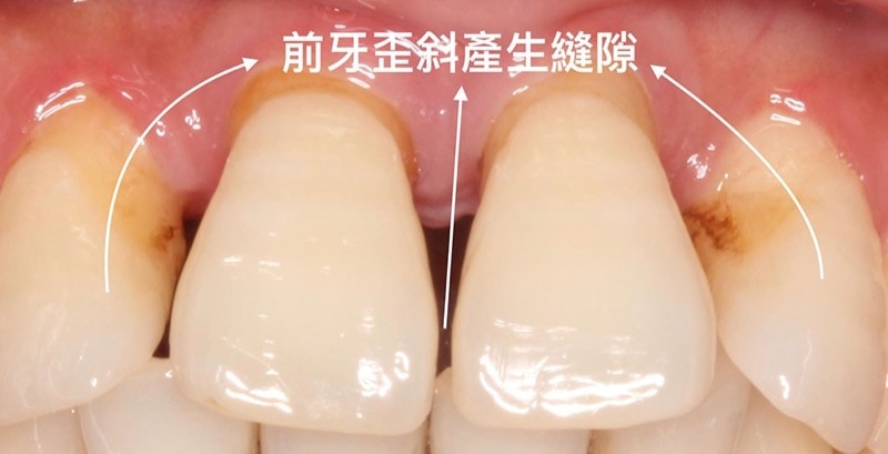 嚴重牙周病經驗治療案例-前牙歪斜產生縫隙-病理性位移-葉立維醫師-牙周病-桃園