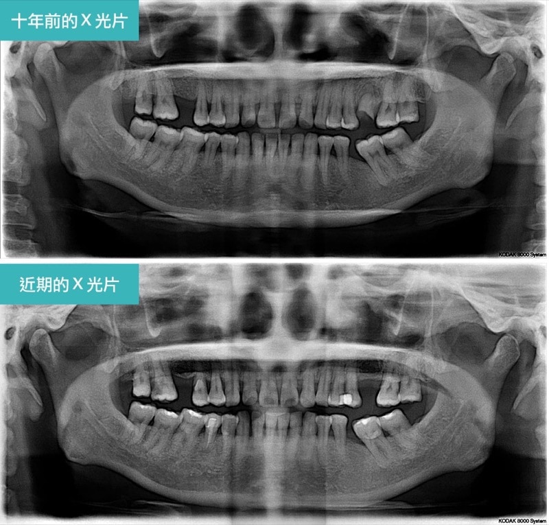 嚴重牙周病經驗治療案例-十年前後環口X光片-葉立維醫師-牙周病-桃園