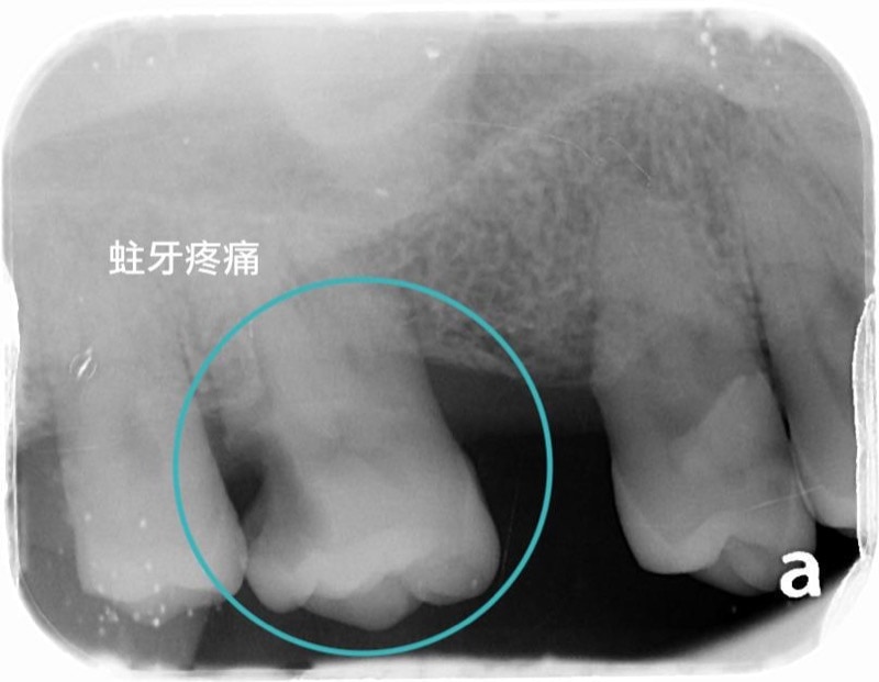 嚴重牙周病經驗治療案例-右上臼齒蛀牙X光片-葉立維醫師-牙周病-桃園