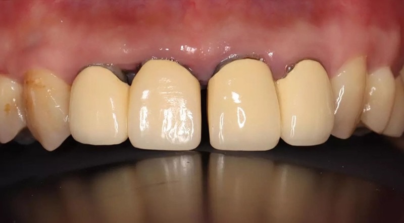 嚴重牙周病經驗治療案例-後牙缺牙-前牙假牙病理性位移-葉立維醫師-牙周病-桃園