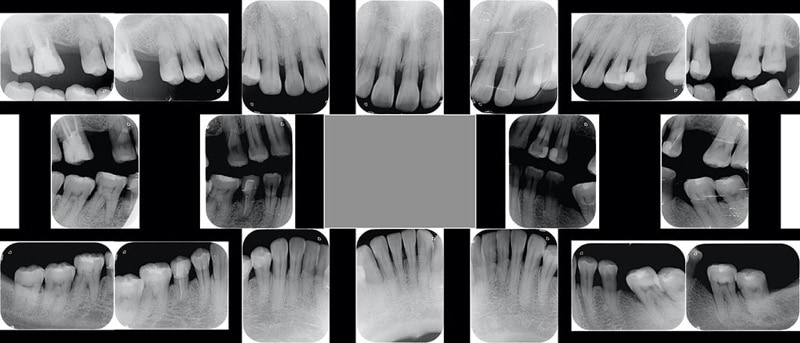 嚴重牙周病經驗治療案例-治療前-各角度口腔內X光照-葉立維醫師-牙周病-桃園
