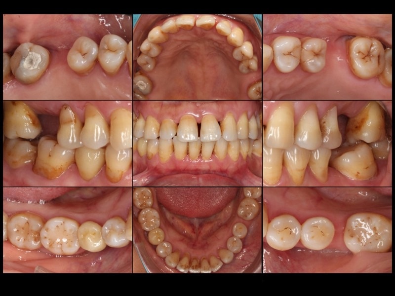 嚴重牙周病經驗治療案例-治療前-各角度牙齒近照-葉立維醫師-牙周病-桃園