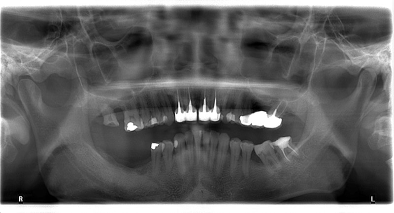嚴重牙周病經驗治療案例-治療前-環口式X光片-葉立維醫師-牙周病-桃園