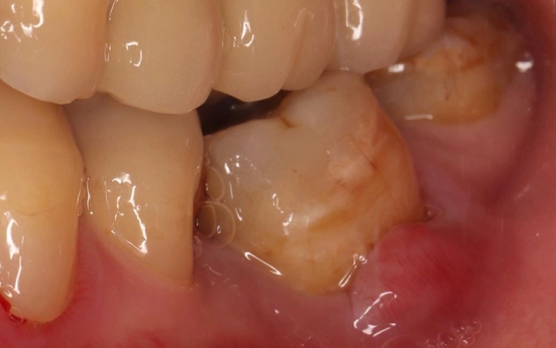 嚴重牙周病經驗治療經驗案例-左下臼齒牙齦腫脹-葉立維醫師-牙周病-桃園