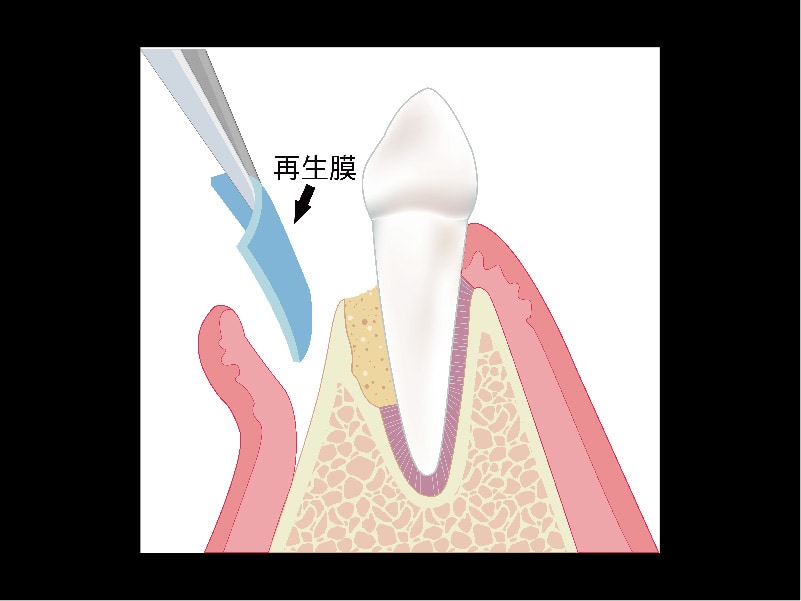牙周再生手術-再生原理圖-再生膜-葉立維醫師-桃園牙周病
